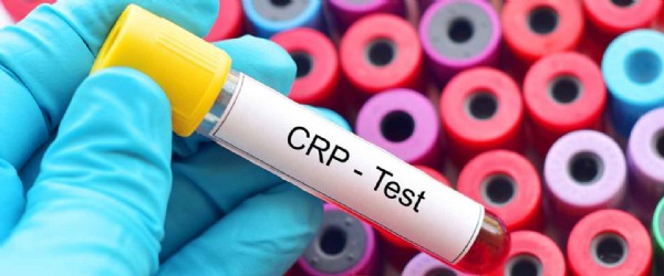 CRP Yüksekliği Nedir? CRP Yüksekliği Neden Olur? CRP Yüksekliği Nasıl Tedavi Edilir? CRP Yüksekliği Nedir? CRP Yüksekliği Neden Olur? CRP Yüksekliği Nasıl Tedavi Edilir?